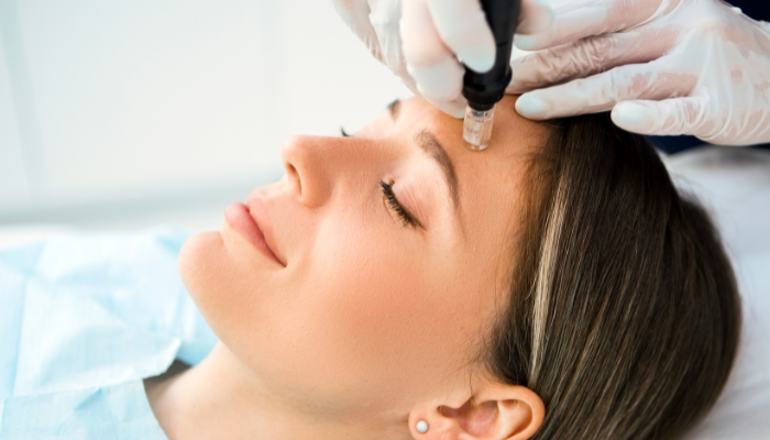 Dermapen Micro-needling: What to expect and aftercare